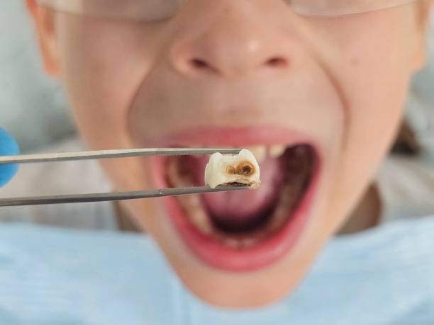 Best Emergency Tooth Extraction in Roebling, NJ